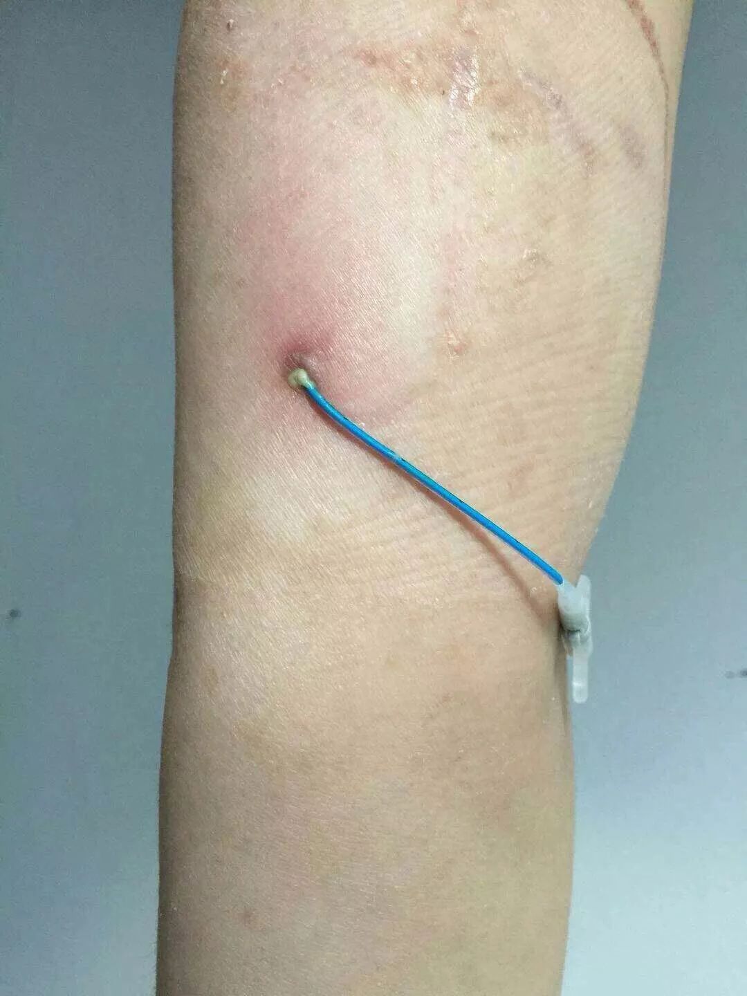 picc置管后周围肿胀原因及处理,picc管夏天怎么护理