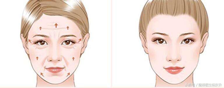 面部大小拉皮手术的区别,大拉皮手术面部多久恢复自然