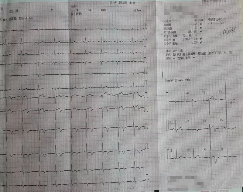 发作性胸痛心电图正常,心电图轻度T波改变图片