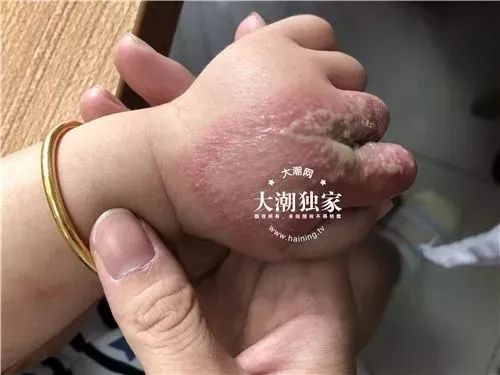 隐翅虫的图片和它的危害,隐翅虫严重后果图片