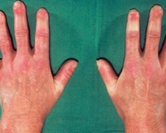 皮肤肿物门诊能报销吗,皮肤长小疙瘩做冷冻医保能报吗