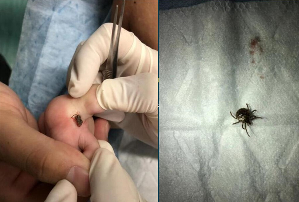 宝宝被蚊虫叮咬最好的解决办法,宝宝被蚊虫叮咬后有什么好办法吗