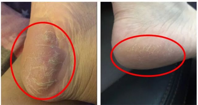 擦掉一张皮，双脚换皮术！死皮、老茧一喷就没，15秒还原嫩白玉足