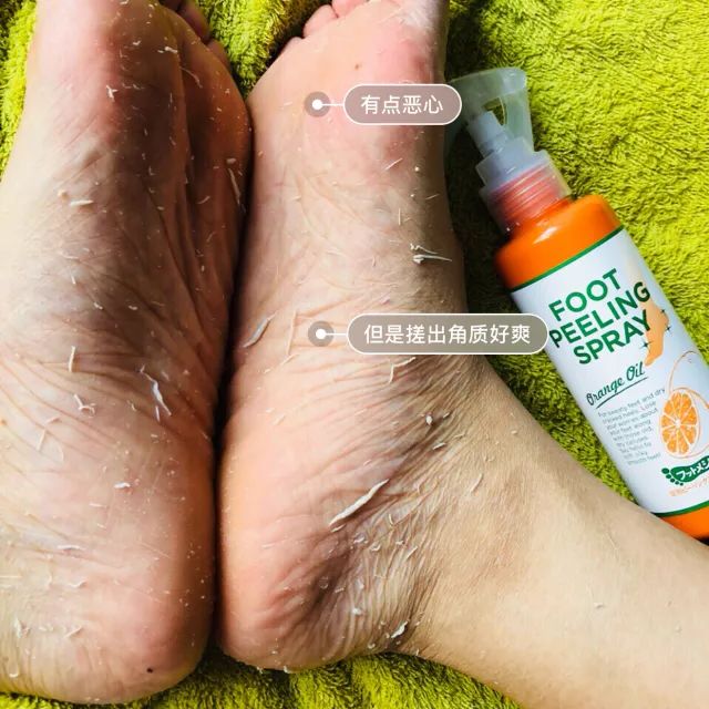 擦掉一张皮，双脚换皮术！死皮、老茧一喷就没，15秒还原嫩白玉足