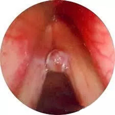 声带息肉怎么治疗最好,声带息肉和会厌囊肿能同时手术吗