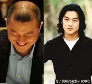 大额头怎么拥有完美发际线,发际线干货分享