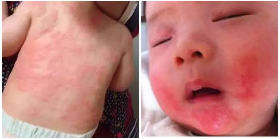 如何通过日常护理来预防湿疹复发,宝宝湿疹大人怎么办
