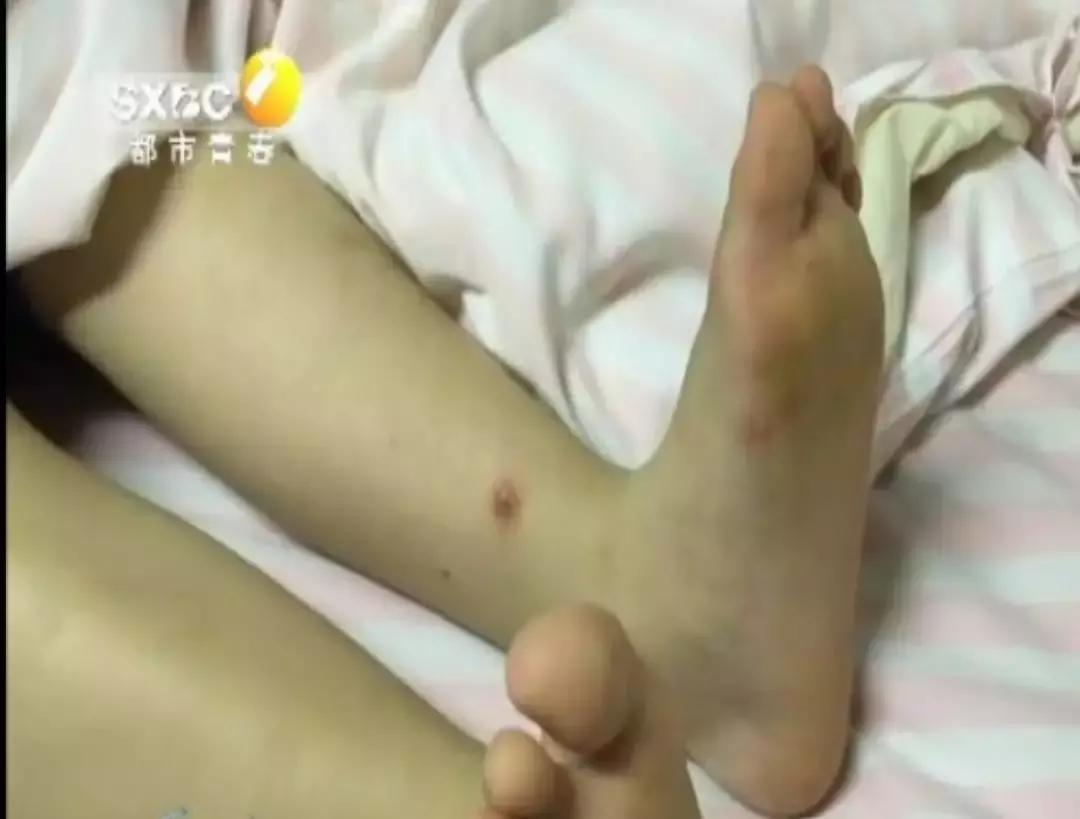 幼儿园手足口病会致人死亡吗,幼儿园因手足口病通知患者家长