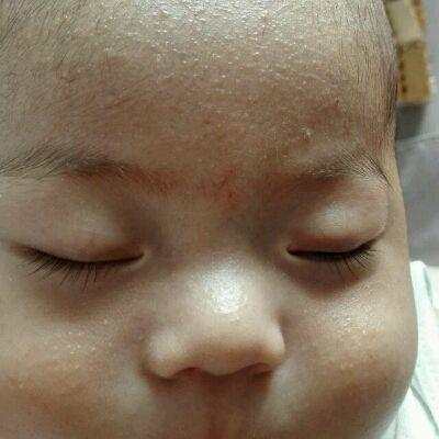 治疗宝宝湿疹比较好的药膏,治疗宝宝湿疹最好的中医院