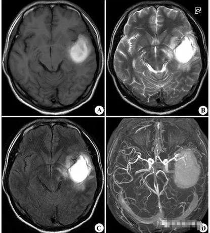 脑出血分期及影像学表现,脑出血各个部位的临床表现