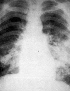 肺水肿和左心衰如何鉴别诊断,蝶翼征