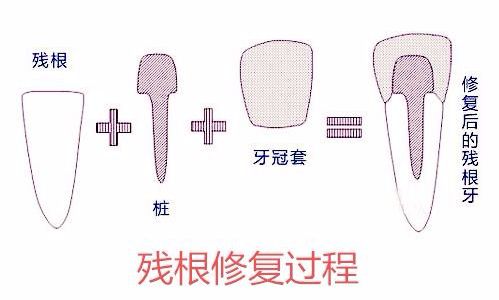 不能随便拔牙的原因,不能拔牙但是牙坏了怎么办