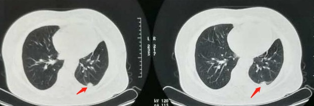 治疗癌症的靶向药能不能停,靶向治疗药物任何癌症都可以吃吗