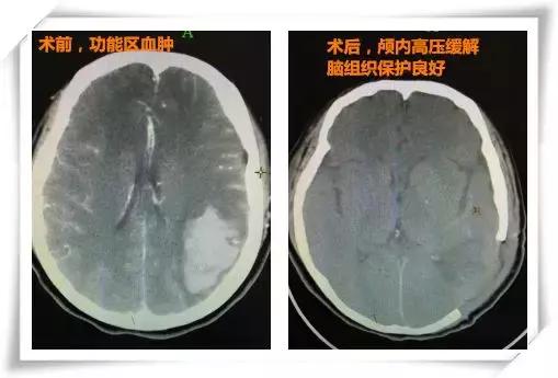 脑出血半年多了脑壳晕能治愈吗,查出脑出血手术打开脑壳很严重吗