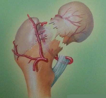 吃钙片能预防股骨头坏死吗,按摩腹股沟预防股骨头坏死