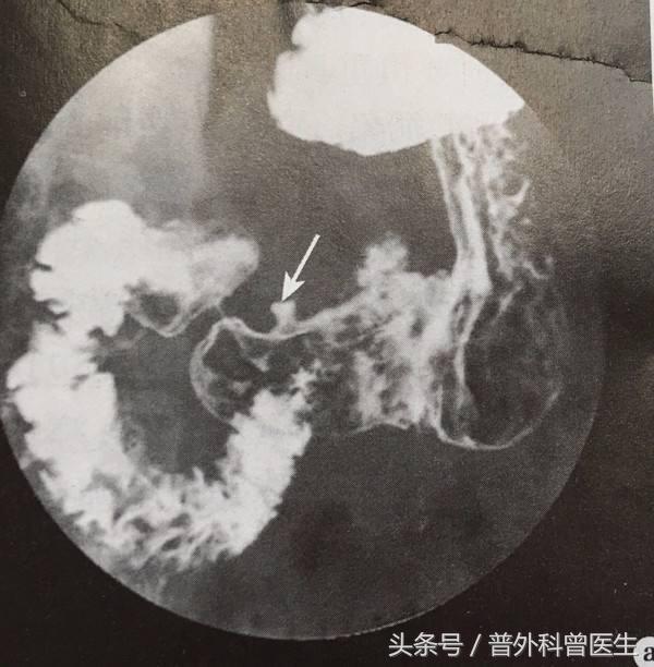 做胃镜没问题为什么胃还是不舒服,胃不舒服是喝钡餐检查还是做胃镜