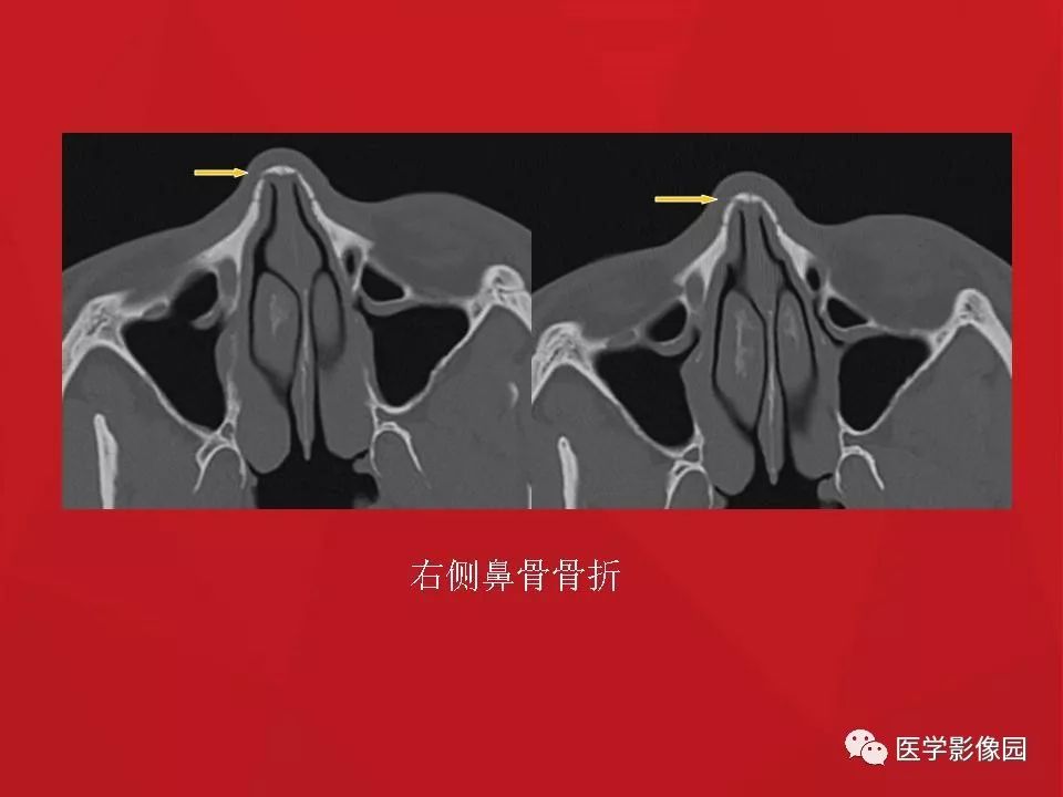 左侧鼻骨骨折伴鼻中隔骨折,双侧鼻骨及左上颌骨突骨折