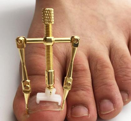 脚指甲长到肉里面怎么剪,脚指甲长到里面去了怎么剪