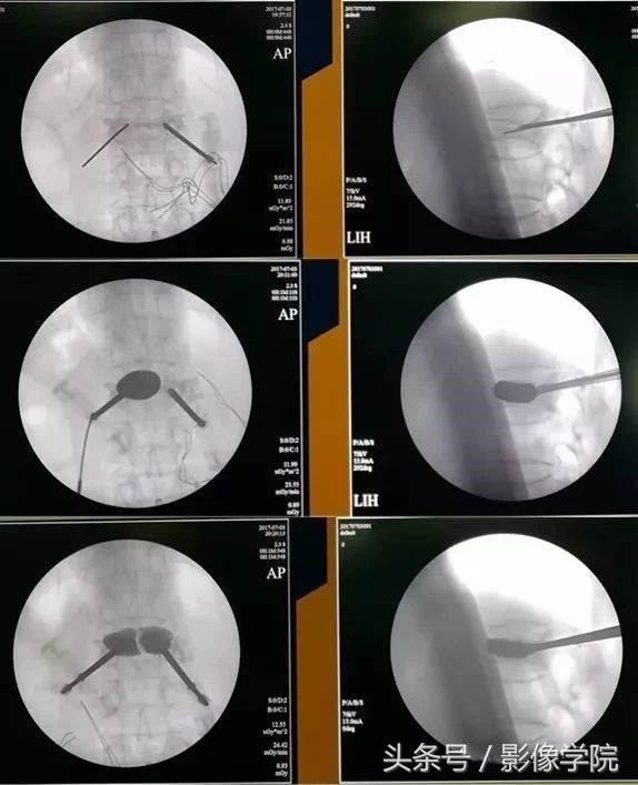 骨质疏松引起的老年性腰椎骨折,胸11椎体压缩性骨折怎么治疗
