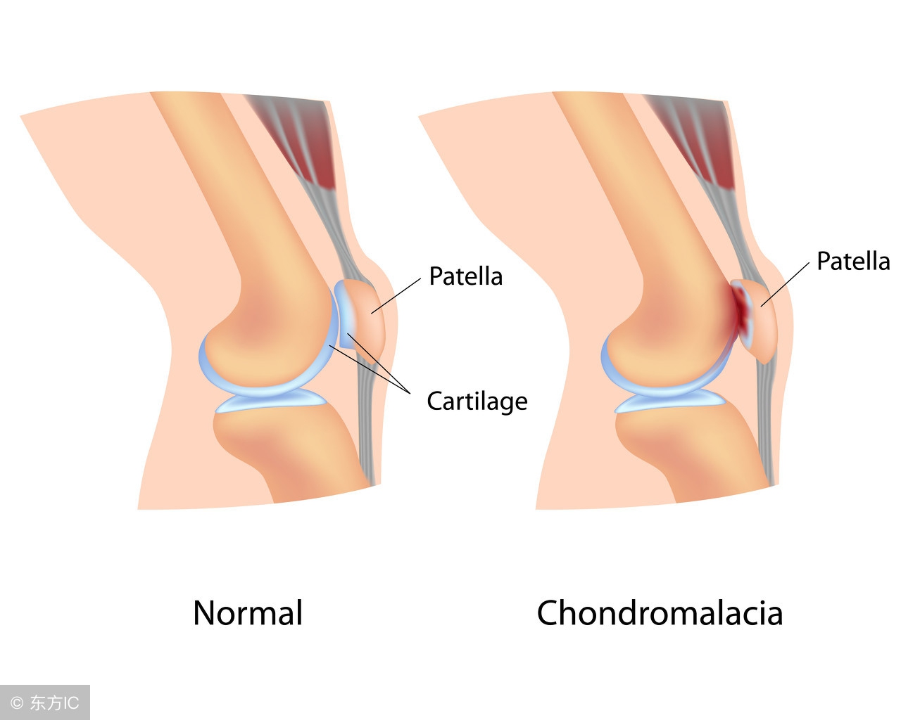 跑步导致膝关节损伤,膝关节软骨磨损可以跑步吗