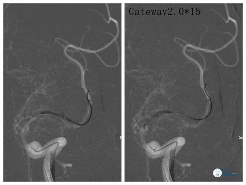 大脑中动脉支架术后再狭窄的几率,天坛医院介入脑血管手术