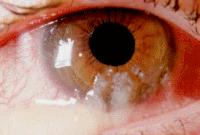 超急性细菌性结膜炎首选药物,医生是怎么治疗急性结膜炎的