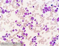 慢性白血病格列卫,慢性粒细胞白血病格列卫