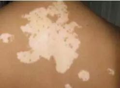 邯郸中药调理白癜风中医诊所,邯郸一院能治白癜风吗