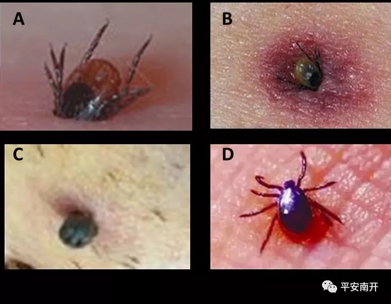 津城现疑似蜱虫叮咬病例？专家来解读！「平安警务室」