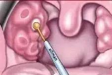 小孩反复扁桃体发炎发烧要切除吗,小孩经常扁桃体发炎发烧能切除吗