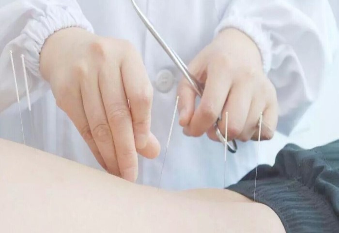 针灸治疗乳腺炎有用吗,乳腺炎针灸穴位视频