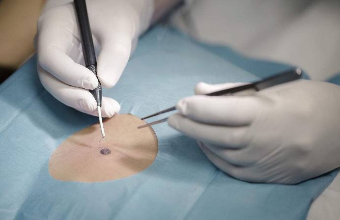 注意了身上长这5种痣特容易癌变,痣出现哪些变化是恶变的征兆