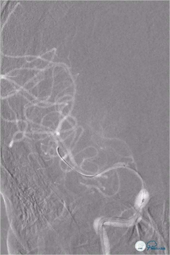 天坛脑血管动脉瘤介入手术,天坛医院脑动脉狭窄