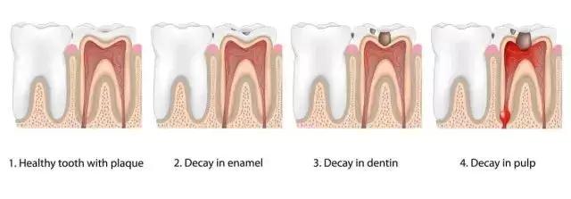 蛀牙痛了几天吃药也不见好怎么办,治疗一颗蛀牙很痛吗