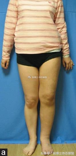 矫正长短腿去哪里矫正,体态矫正腿