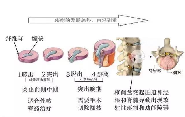 腰突正骨操每天10分钟,老中医教你腰椎突出锻炼