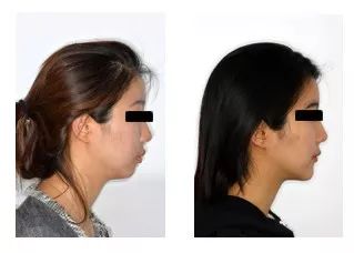 暑期孩子想矫正牙齿？北京口腔医院专家来解答这10个问题