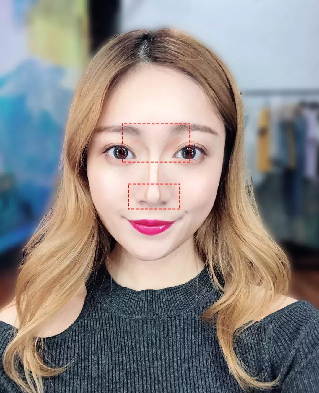 蒜头鼻怎么改变鼻型,蒜头鼻厚鼻翼怎么矫正