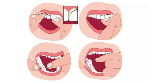 冲牙器改善牙龈出血,超声波冲牙器清洁牙垢是否有效果
