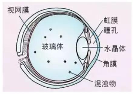 飞蚊症怎么回事呀,飞蚊症一招就搞定
