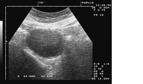 卵巢早衰怎么治疗能怀孕,卵巢囊肿影响怀孕吗怎么治疗