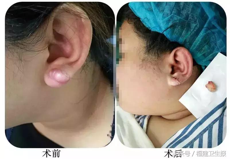 21岁女孩打耳洞后耳朵长出鸽子蛋,打耳洞长出肉疙瘩的概率多大