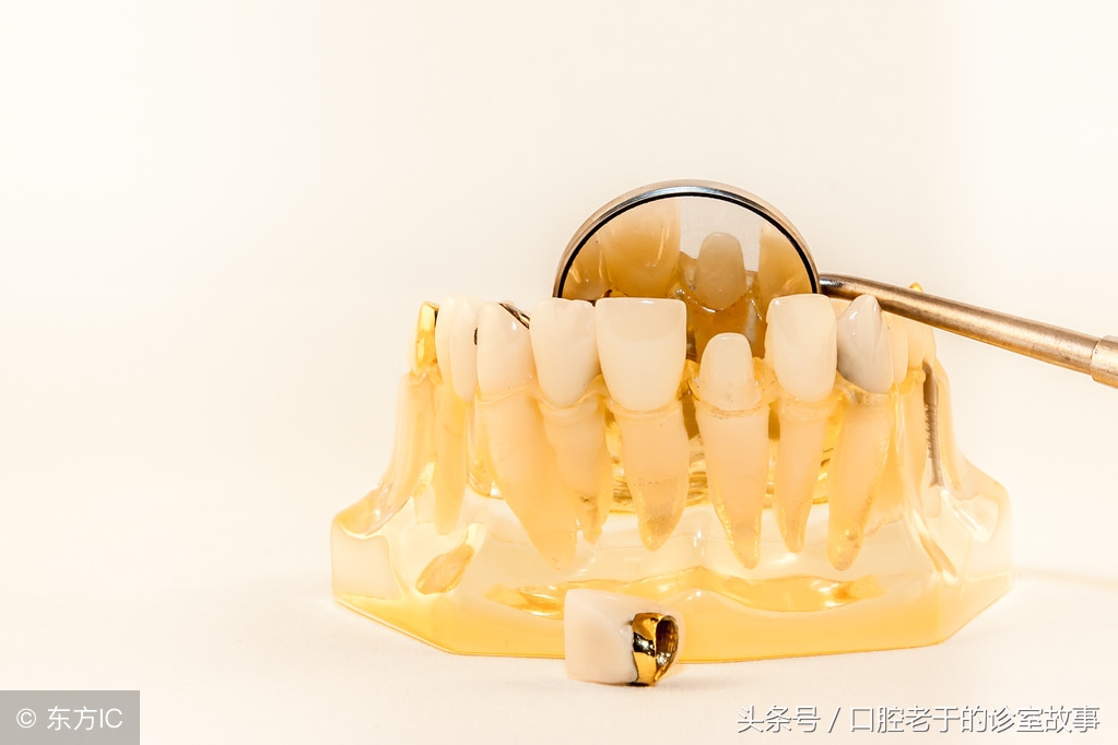 大部分人选择哪种烤瓷冠,一颗全烤瓷冠多少钱