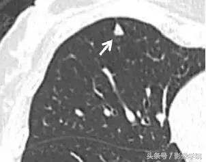 肺结节14种影像,一百例有结果的肺结节影像分析