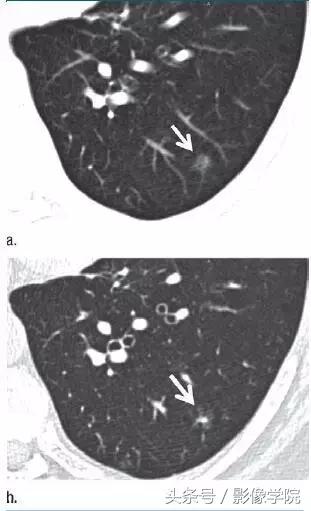 肺结节14种影像,一百例有结果的肺结节影像分析