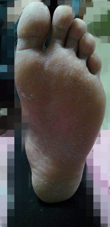 脚臭脱皮不痒是脚气吗,脚气老不好和脾有关系吗