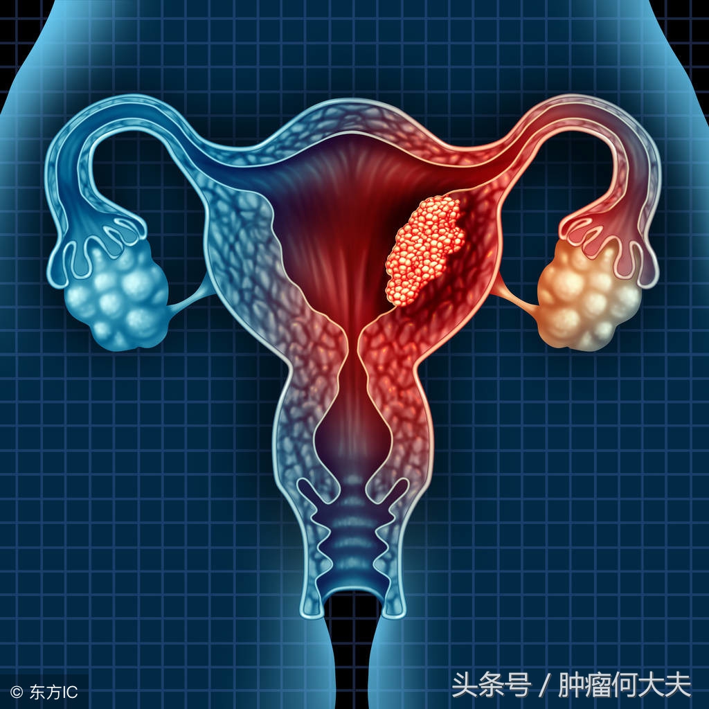 妇科有肿瘤会出现什么症状,妇科肿瘤一般是什么症状