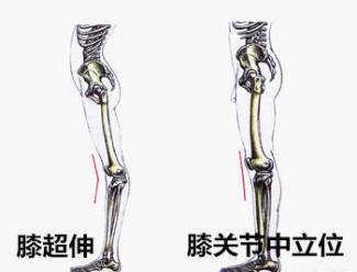 膝超伸导致的小腿粗如何解决,小腿超粗是什么原因