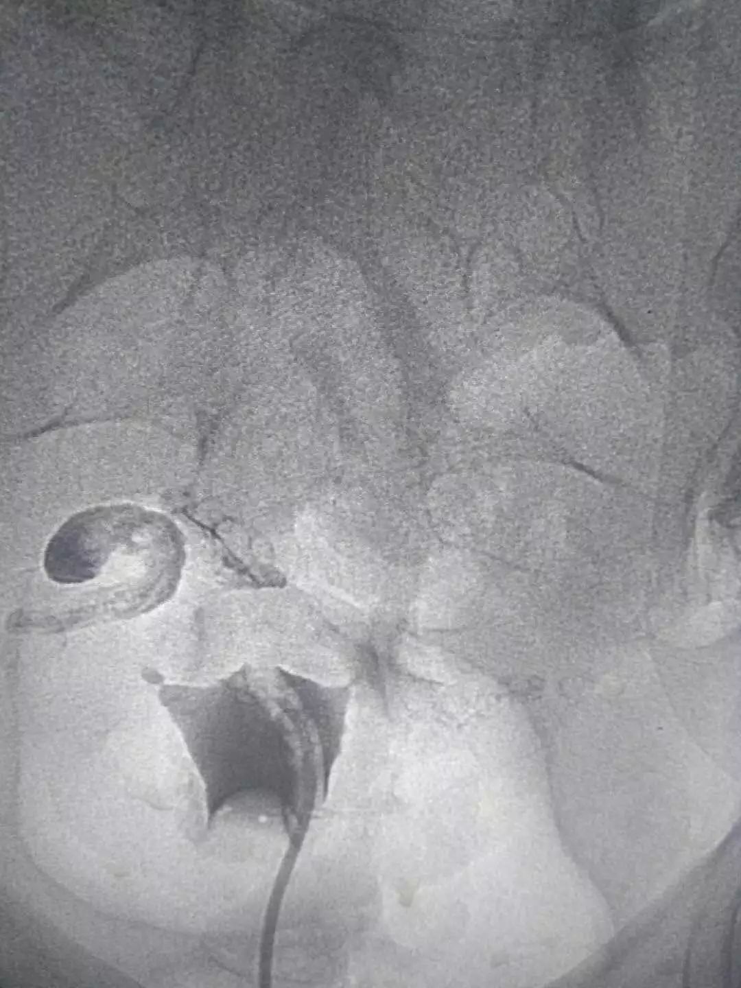 输卵管堵塞介入治疗法是怎么回事,输卵管堵塞介入治疗