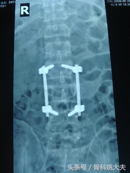 腰椎骨折以后应该怎么办？